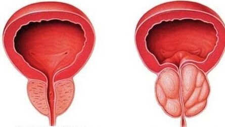 normal och inflammerad prostata