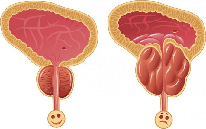 frisk och inflammerad prostata med prostatit