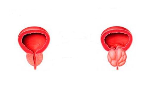 frisk och inflammerad prostata med prostatit