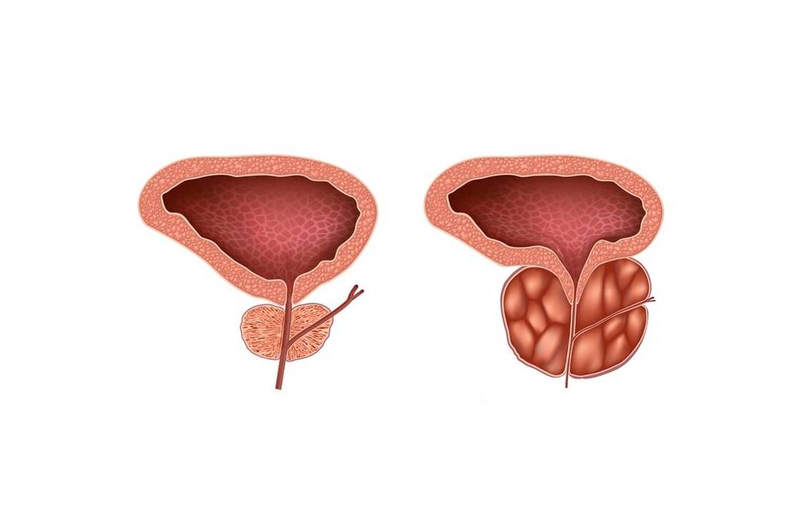 symtom på prostatit hos män