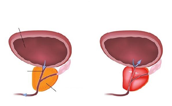 normal och inflammerad prostata