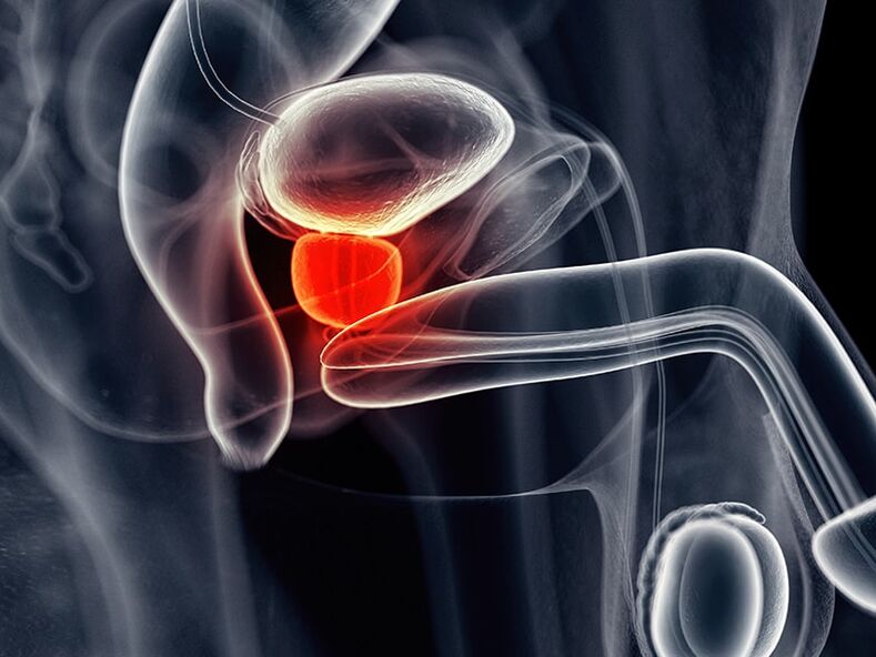 Inflammation i prostatakörteln som åtföljer kronisk prostatit