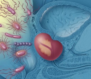 Inflammation i prostata