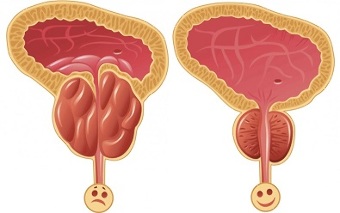 hur fungerar ProstEro prostatit före och efter behandling